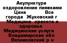 Акупунктура, оздоровление пиявками › Цена ­ 3 000 - Все города, Жуковский г. Медицина, красота и здоровье » Медицинские услуги   . Владимирская обл.,Вязниковский р-н